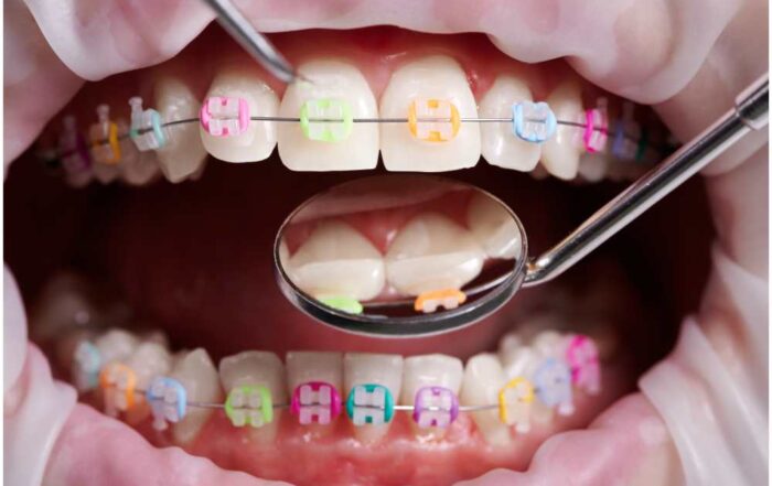Diş Teli Nedir?