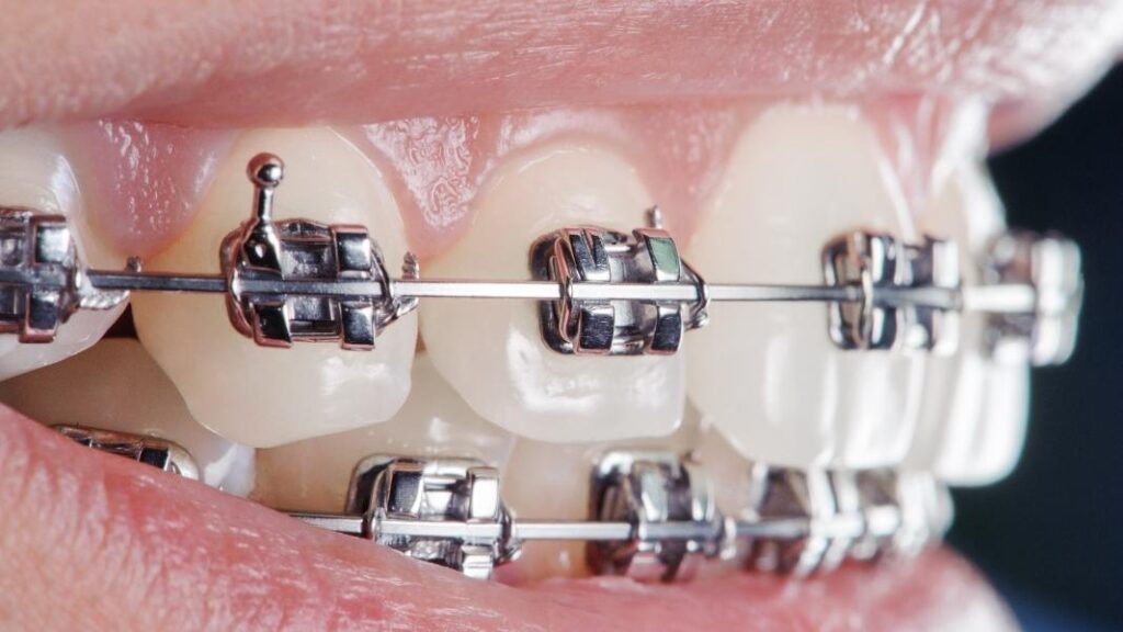 mersin ortodonti (3)