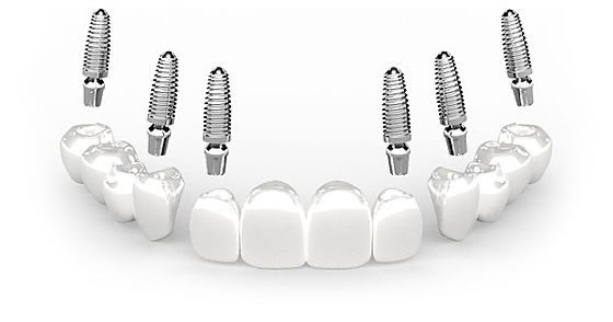 3-on-6 dental implants